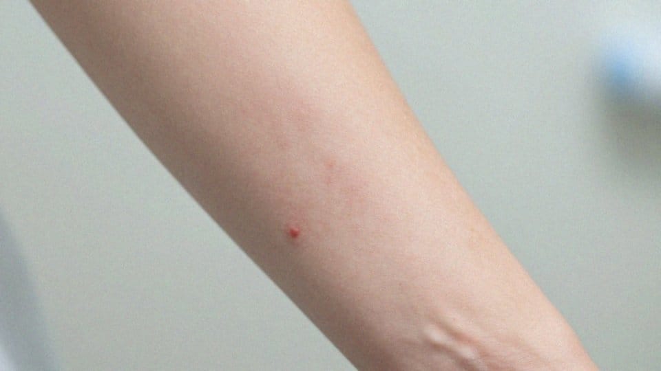 Kiedy półpasiec powinien budzić podejrzenie nowotworu?