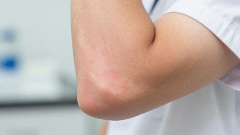 Jakie są objawy boreliozy 2. stopnia?