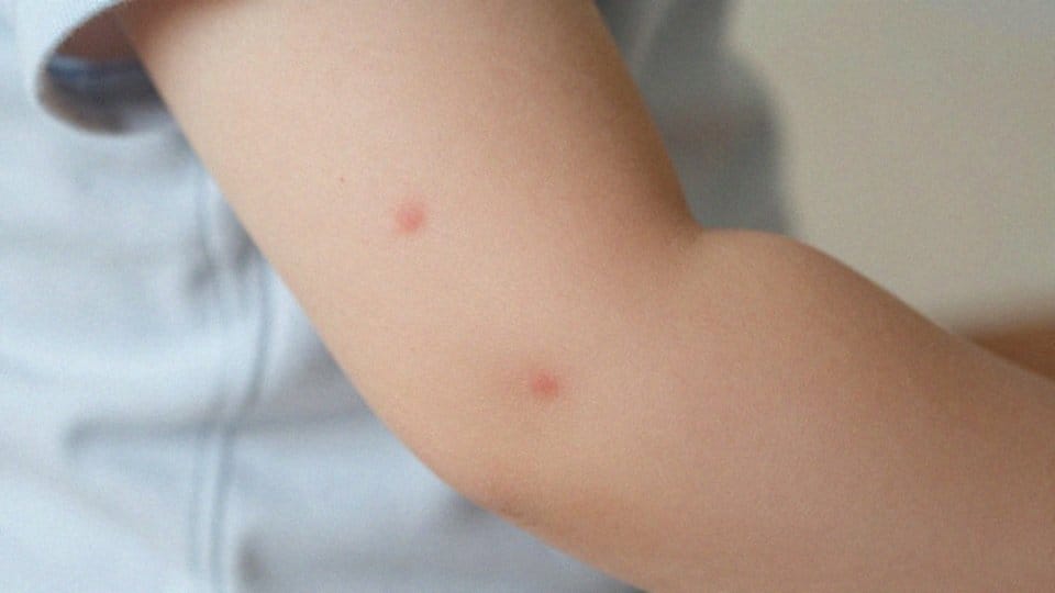 Jakie objawy świadczą o zakaźności ospy wietrznej?